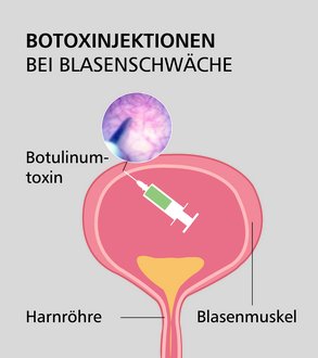 Grafik die das Verfahren erklärt